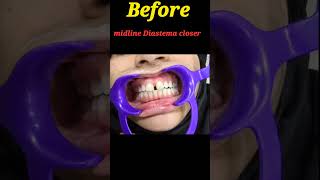 Midline diastema closer dentist teeth youtubeshorts viralshort sorts trending dentalcare [upl. by Imuyam]