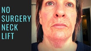 My Neck Results preliminary From Fibroblast Therapy [upl. by Yeoz]