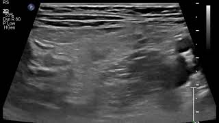 Ileocecal tuberculosis ultrasound [upl. by Upshaw623]