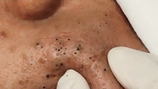 Satisfying Blackhead Removal [upl. by Guidotti585]