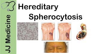 Hereditary Spherocytosis  Pathophysiology Symptoms Diagnosis and Treatment [upl. by Mill]