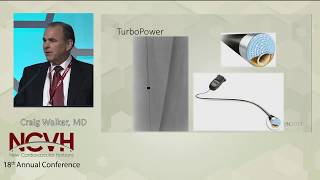 New Tools in Laser Atherectomy Spectranetics Laser [upl. by Ylrebmik838]