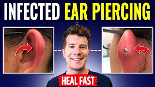 Doctor explains HOW TO RECOGNIZE AND TREAT INFECTED EAR PIERCING [upl. by Treblig930]