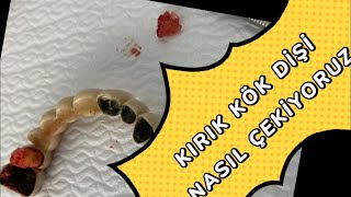 Diş çekimikırık diş kökünün çıkarılmasıtooth extraction broken tooth root extractionasmr [upl. by Ahsekim386]