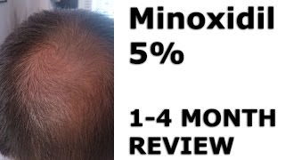 Minoxidil Hair Regrowth  Before amp After 14 Months [upl. by Karita]