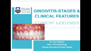 GINGIVITIS STAGES amp CLINICAL FEATURES [upl. by Wilkey728]