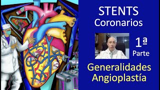 Stent Coronario 1a Parte ✅ Angioplastía Coronaria Placas de Colesterol 🔔 [upl. by Cedar]