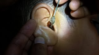 Fully blocked Ear Wax Removal [upl. by Brunell]