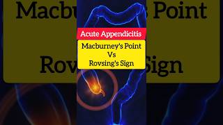 Mcburneys Point vs rovsings Sign in acute appendicitis surgery [upl. by Norris406]