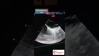 Perimembranous VSD  VSD  congenital heart anomalies  VSD Echo [upl. by Sackman]