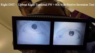 Right Posterior Semicircular Cupulolithiasis with Positive Inversion Test [upl. by Jeane]