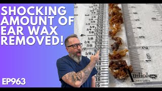 The Most Shocking Ear Wax Removal Ever  EP963 [upl. by Anilek33]