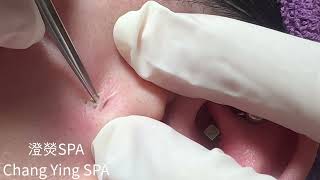 桃園中壢清粉刺 臉頰黑頭清除 Blackheads on face Removal！ [upl. by Eicnahc]