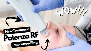 Potenza RD Microneedling Treatment Moncton NB Sparkle MediSpa [upl. by Oiramrej711]