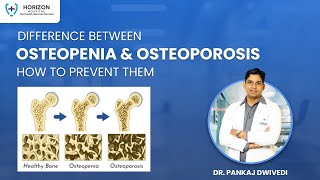 Difference between Osteopenia and Osteoporosis by Orthopedic Dr Pankaj Dwivedi [upl. by Ybor]