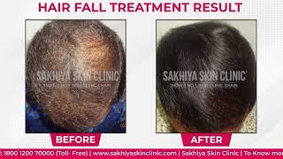 Hair Fall Treatment Success Story Best treatment for har loss Review Sakhiya skin clinic Review [upl. by Yniar876]