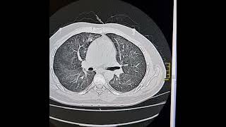 Pneumocystis jirovici pneumonia [upl. by Rusert]