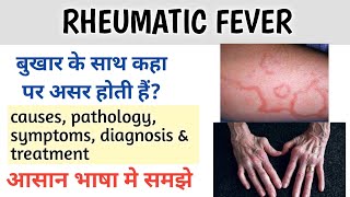 Rheumatic fever  causes pathology symptoms diagnosis amp treatment [upl. by Gaylord]