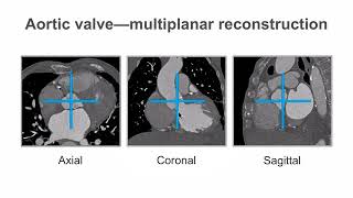 How to evaluate the aortic valve using cardiac CT imaging [upl. by Cohlier]