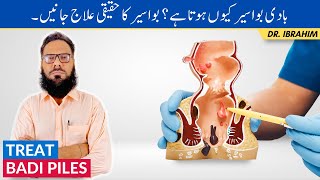 Badi Bawaseer Ka Ilaj  PilesHemorrhoids Causes amp Treatment  Piles Ka Ilaj  UrduHindi [upl. by Zenger610]