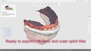 Proof of concept  3D printed resin bilaminar hardsoft splint  design and printing workflow [upl. by Haisi]