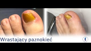 Po usuwaniu wrastającego paznokcia  wizyta kontrolna  After ingrown nail removal  control visit [upl. by Enetsirhc]