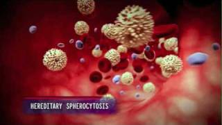 How Hereditary Spherocytosis Causes Anemia [upl. by Viviyan]