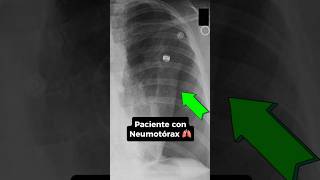 Cuál es el mejor modo ventilatorio para paciente con Neumotórax ⁉️🫁 emergency [upl. by Amorette]