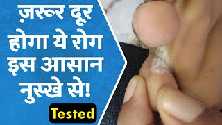 पैरों की उँगलियों के फंगस का देसी घरेलू इलाज  How to Get Rid of Athletes Foot Forever [upl. by Leuas663]