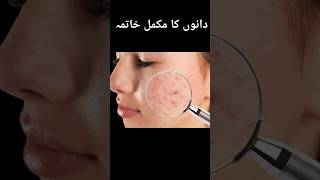 Pimples ampAcne solution ytshortstrendingviralbeautytipssimplebeautytipsdiy [upl. by Ayatal]