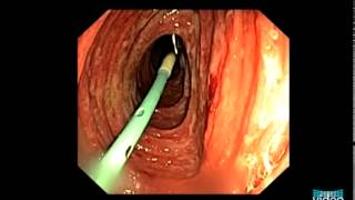 Vascular Lesions in the Small Bowel [upl. by Yendyc]