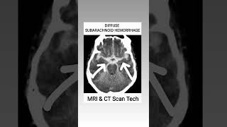 Subarachnoid Hemorrhage CT Scan viral youtubeshorts ct shortsfeed [upl. by Aniar330]