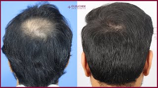 Crown Hair Transplant  Temple Point Recreation  Crown Hair Transplant Result [upl. by Ahsiekar]