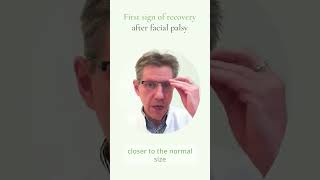 The first sign of recovery after facial palsy Bells palsy amp Ramsay Hunt Syndrome [upl. by Oiratnom]