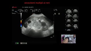 oncocitomi multipli ai reni [upl. by Bores]