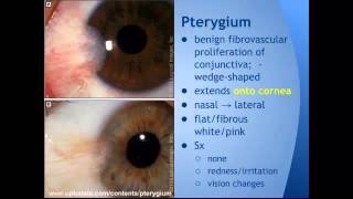 Pterygium vs Pinguecula quotEM in 5quot [upl. by Tan]