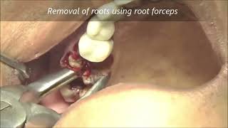 Decayed molar and root stumps extraction by DrCMurugavel [upl. by Cyn]