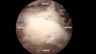 Endoscopic decompression for lumbar stenosis by UBE [upl. by Mcwilliams645]