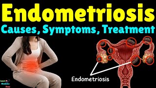 Endometriosis Causes Symptoms Diagnosis Treatment Complications amp Prevention [upl. by Wester]