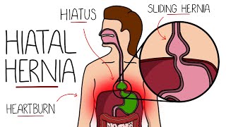 Hiatal Hernia Explained Hiatus Hernia [upl. by Quita]