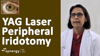 Laser Iridotomy for Glaucoma  Yag Laser Pi Peripheral Iridotomy [upl. by Rosane]