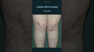 Livedo Reticularis Causes osce practicalmedicine diagnosis sle [upl. by Malissia]