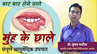 मुंह के छाले Muh ke chhale  Mouth Ulcers [upl. by Wheeler]