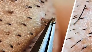 Ingrown hair removal compilation😌 [upl. by Harbird448]