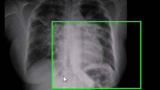 Chest xray lamellar effusion [upl. by Yadnil]