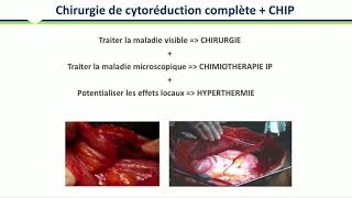 Métastases péritonéales synchrones [upl. by Korie]