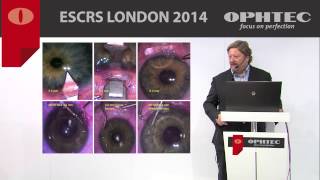 Zero astigmatism outcomes in Phakic IOL implantation by Prof M Pozharitsky Russia [upl. by Nwahsit]