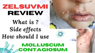 Zelsuvmi Gel A Comprehensive Guide to Treatment for Molluscum Contagiosum [upl. by Nhguaval]