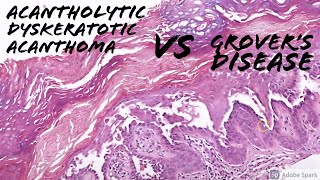 Acantholytic Dyskeratotic Acanthoma vs Grovers Disease 5Minute Pathology Pearls [upl. by Brost]