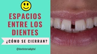 Espacios entre los dientes ¿Cómo cerrarlos Ortodoncia o Diseño de Sonrisa [upl. by Elliven710]